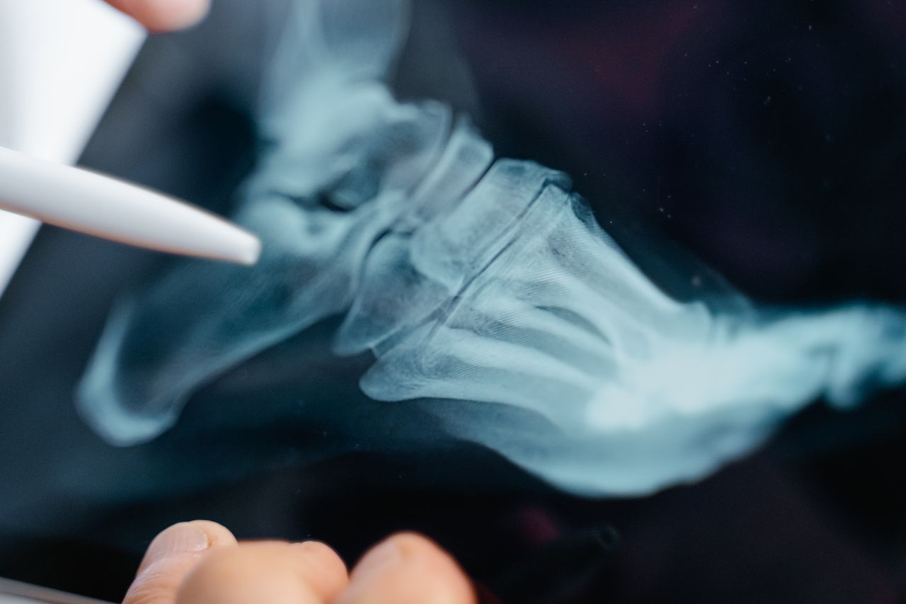 Detailed close-up of a foot x-ray displayed on a digital tablet screen.